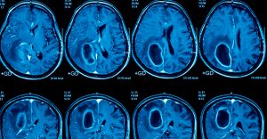 How to treat glioblastoma with graviola and ozone?