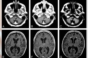 Natural Treatment of Stage 4 Brain Melanoma with Metastasis